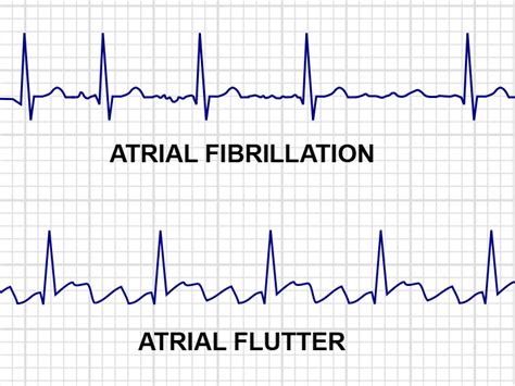 A Flutter Vs A Fib