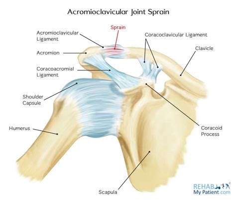 Ac Joint Sprain