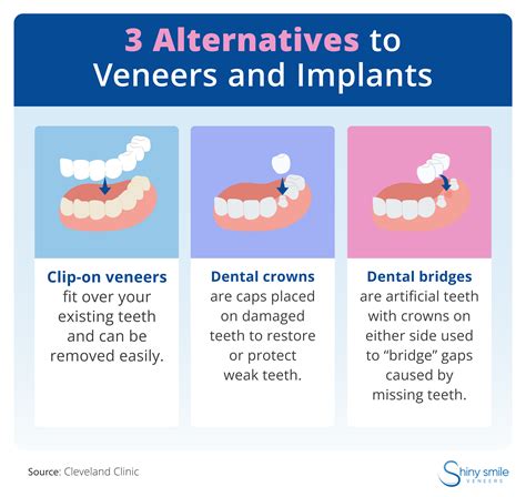 Alternatives To Veneers