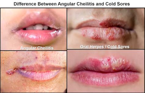 Angular Cheilitis Or Cold Sore