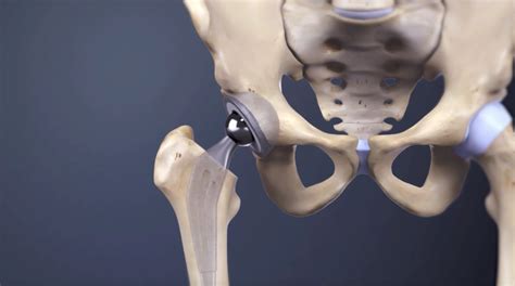 Anterior Method Hip Replacement Surgery