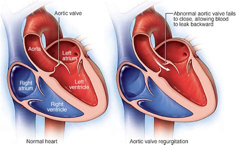 Aortic Valve Regurgitation