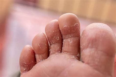 Athlete's Foot Fungus On Hands