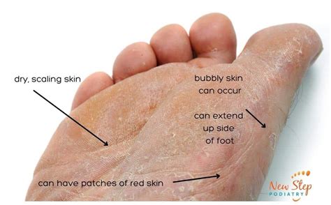 Athlete's Foot Vs Dry Skin