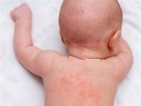 Baby Dry Skin