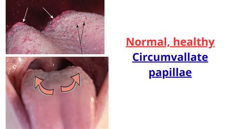 Back Of Tongue Bumps
