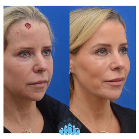 Before And After Photos Of Mohs Surgery On Face