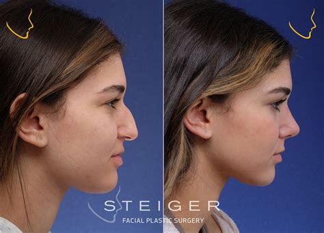 Bigger Nose Surgery