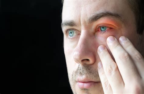 Bite Under Eye