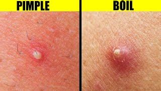 Boil In Vulva