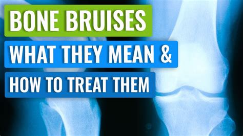 Bone Bruising Recovery