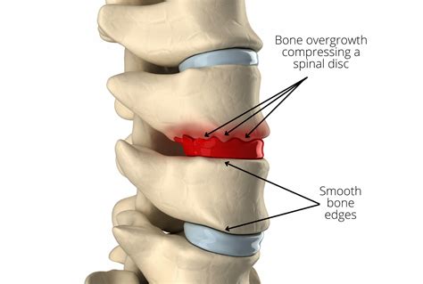Bone Spurs In Back