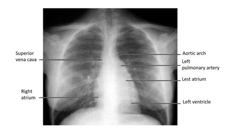 Borders Of Heart In X Ray