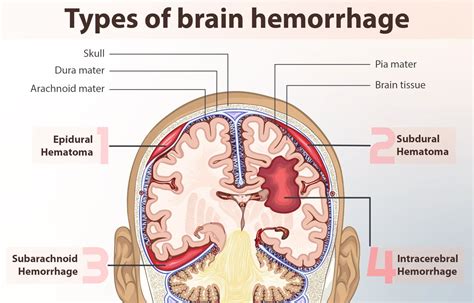 Brain Bleed Surgery