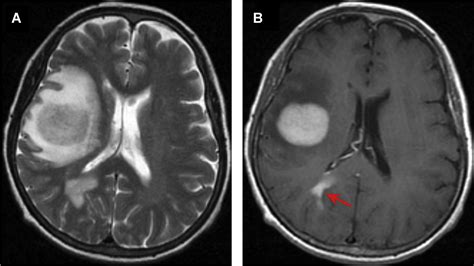 Brain Neoplasm Mri