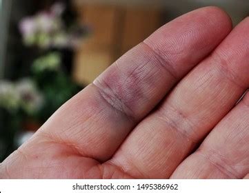 Broken Blood Vessel In Finger
