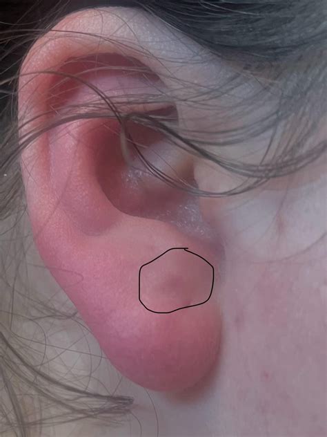 Bump On Earlobe Hurts