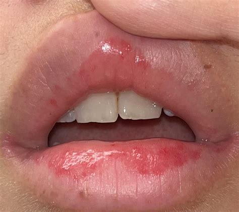 Bumps In The Inner Lip