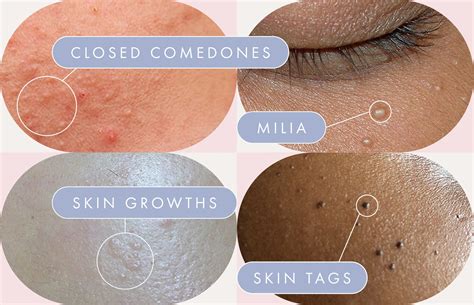 Bumps On Face