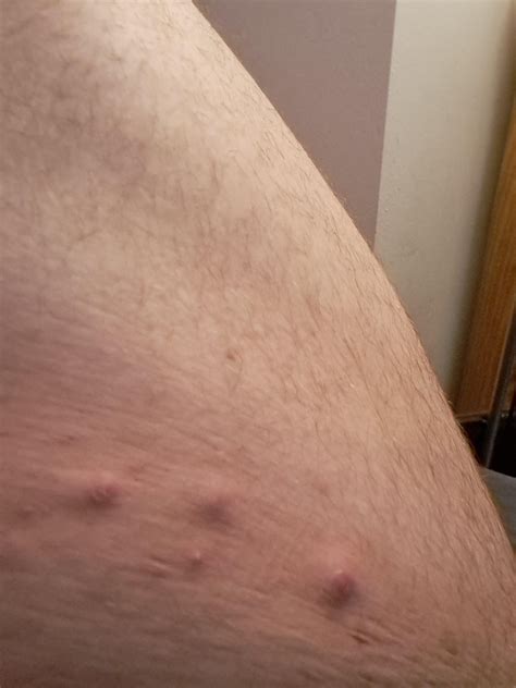 Bumps On Inner Thigh