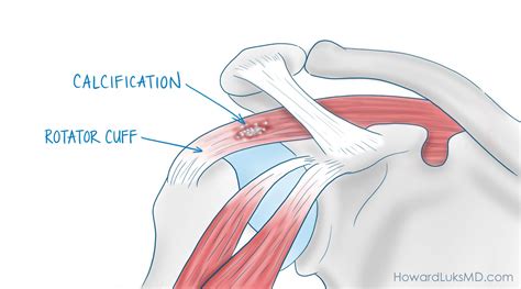 Calcium Deposits In Shoulder