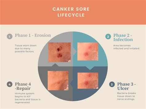 Canker Sore Stages