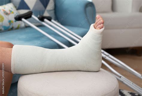 Cast Fractured Ankle