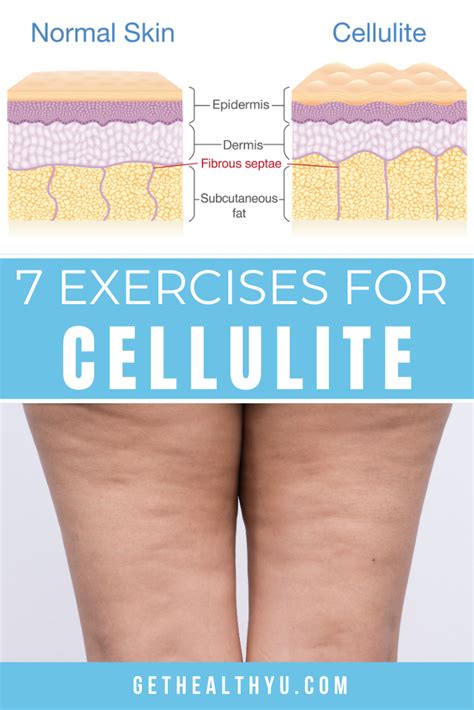 Cellulite On Butt