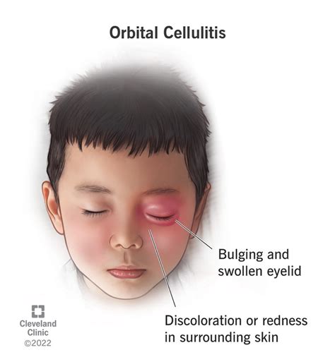 Cellulitis Of The Eye