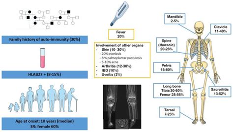 Chronic Multifocal Osteomyelitis
