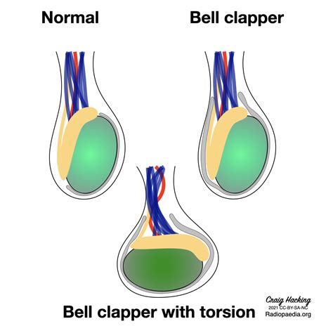 Clapper Bell Deformity