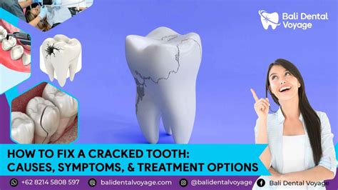 Cracked Tooth Symptoms
