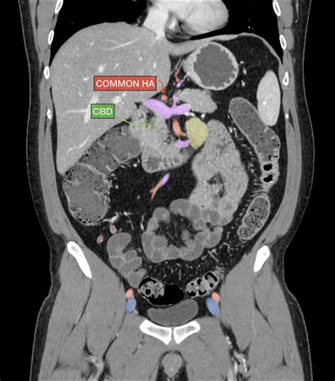 Ct Scan Abdomen