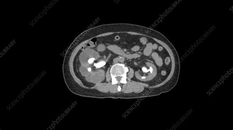 Ct Scan And Kidney Stones