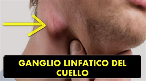 Cuello Ganglios Inflamados