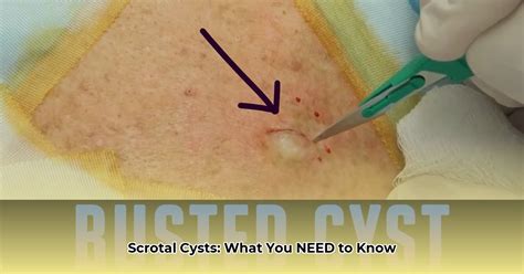 Cyst On Scrotum