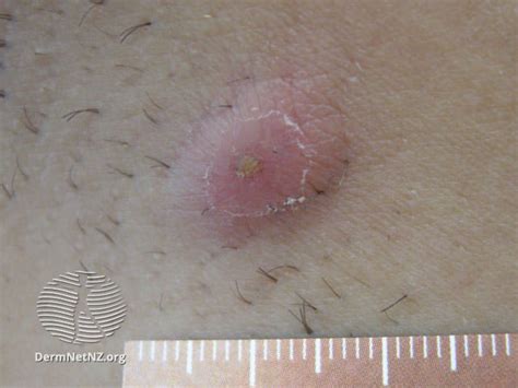 Cysts In Armpit