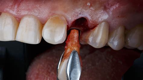 Dentistry Tooth Extraction