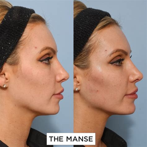 Dermal Fillers Jawline