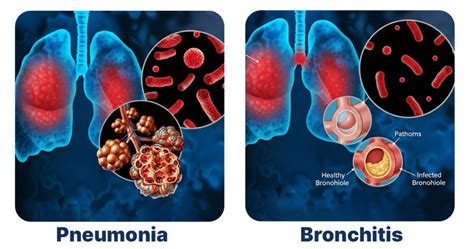 Difference Between Bronchitis And Pneumonia