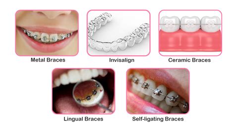 Different Kinds Of Dental Braces