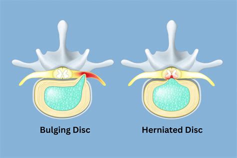Disc Bulge Vs Herniation