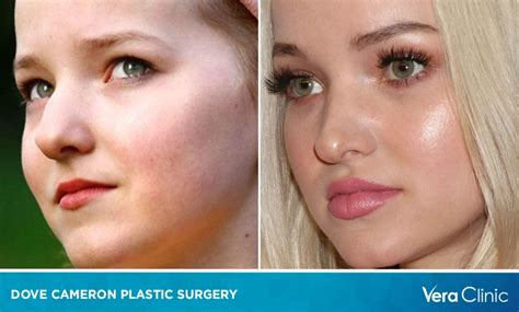 Dove Cameron Surgery Face