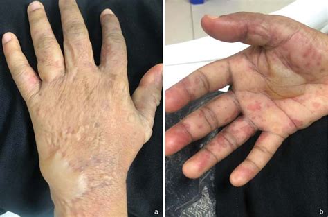 Dry Ice Burn