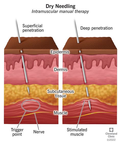 Dry Needling Therapy