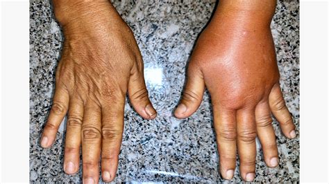 Edema Hands Morning