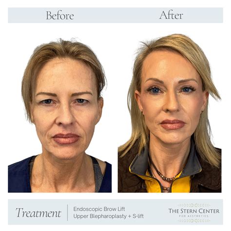 Endoscopic Brow Lift