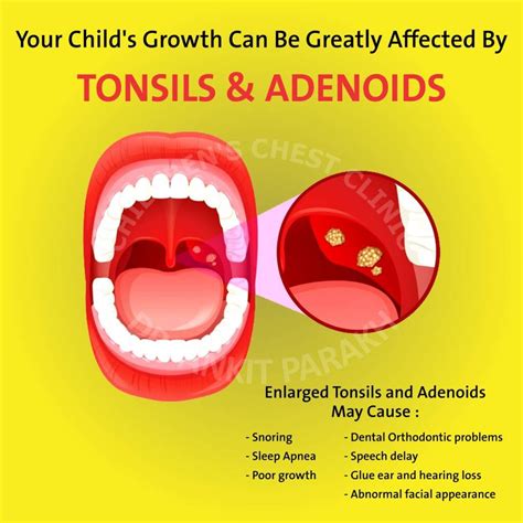 Enlarged Tonsils In Kids