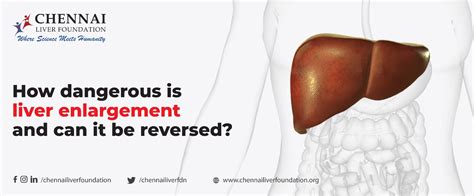 Enlargement Of The Liver