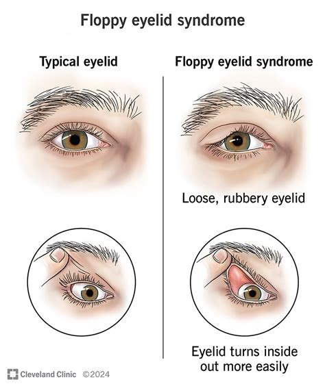 Eyelids Open When Sleeping